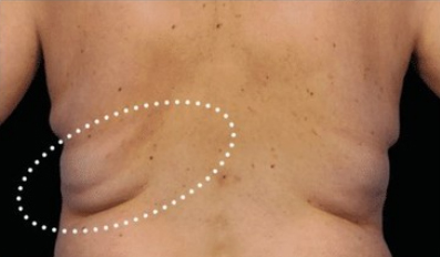 coolscuplting bra fat before midtown manhattan NYC